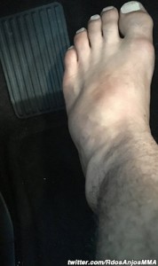 rafael-dos-anjos-broken-foot (1)